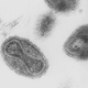 Image for article titled The horrifying story of the last death by smallpox